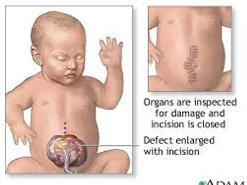 Child omphalocele first stage hernia repair surgery in Deoghar