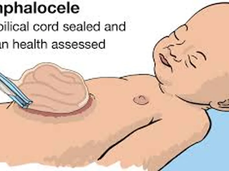 Child omphalocele second stage hernia repair surgery in Deoghar