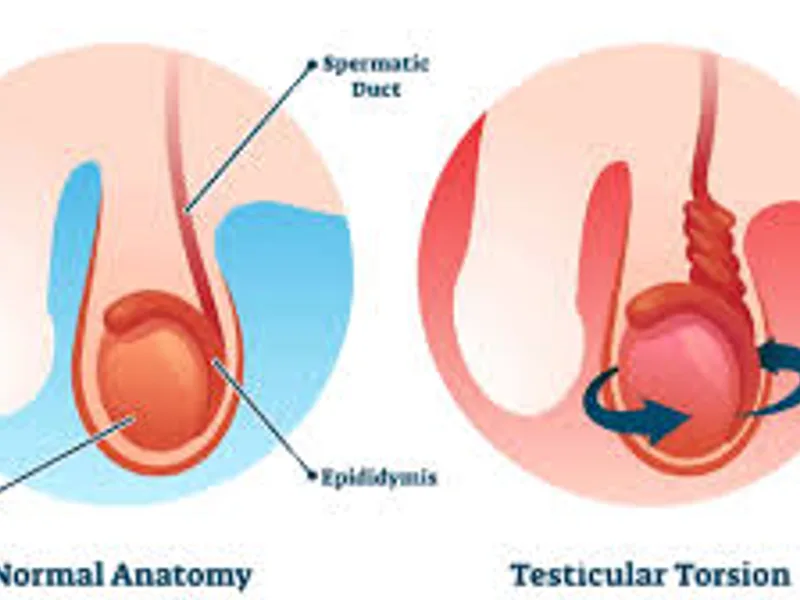 Torsion Testis Operation in Deoghar | Cost, Best Surgeons & Emergency Treatment Guide 2025