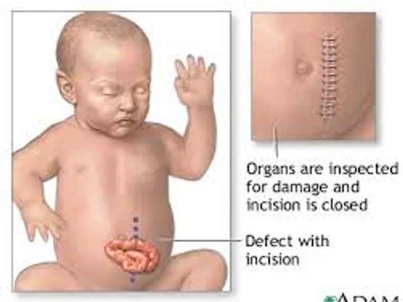 Child Gastroschisis Repair Surgery in Deoghar