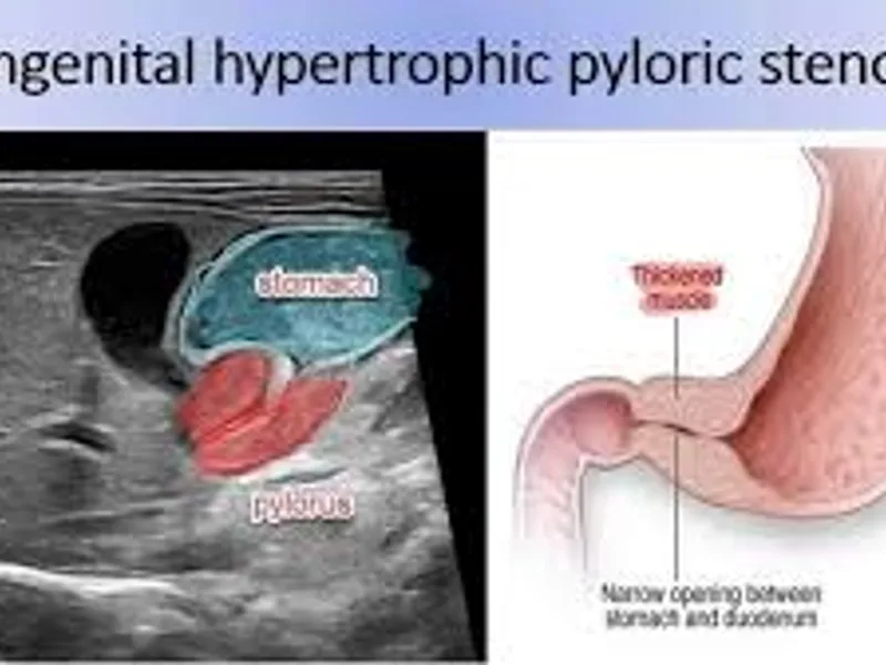 Congenital Hydrocele Surgery in Deoghar | Cost, Best Pediatric Surgeons & Treatment Guide 2025