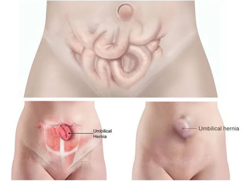 Female Umbilical Hernia Repair Surgery in Deoghar | Best Surgeons, Cost & Reviews 2025