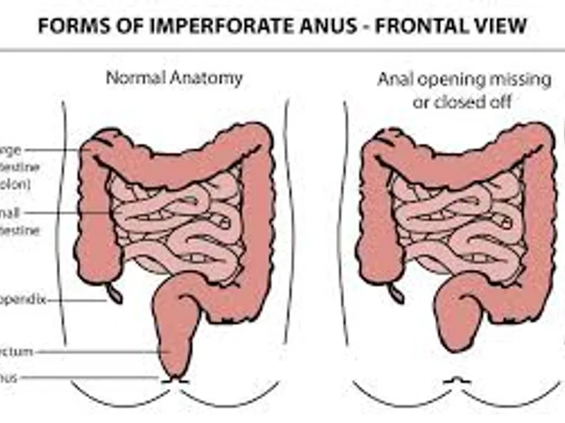Imperforate Anus Low Anomaly Perineal Anoplasty in Deoghar | Cost, Best Pediatric Surgeons & Treatment