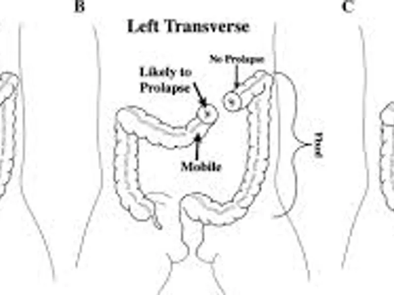 Imperforate Anus High Anomaly Closure of Colostomy in Deoghar | Cost, Best Pediatric Surgeons & Treatment