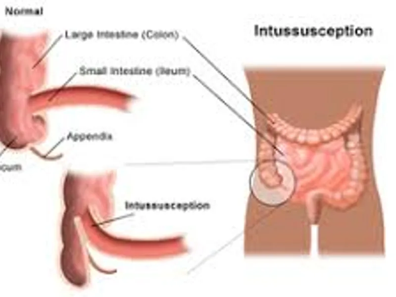 Intussusception Operation Surgery in Deoghar | Cost, Best Pediatric Surgeons & Treatment Guide 2025