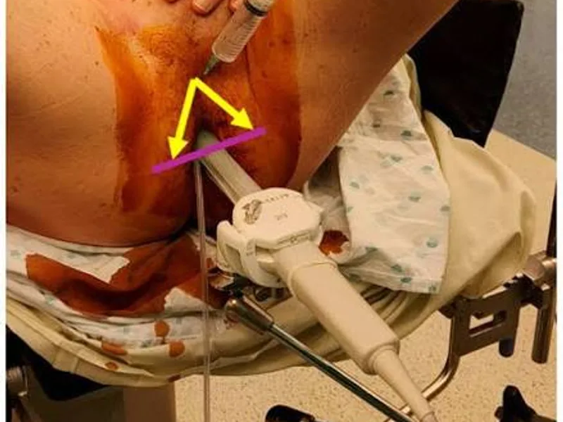 Female Rectal Biopsy Surgery in Deoghar