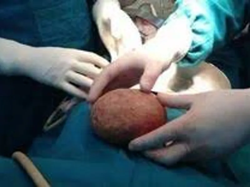 Cystolithotomy Surgery in Deoghar | Cost, Best Surgeons & Bladder Stone Treatment Guide