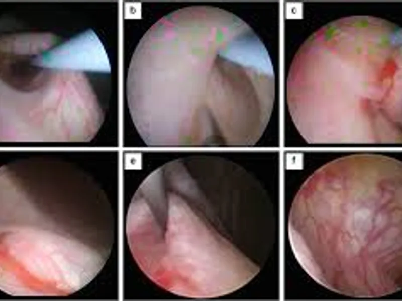 Cystoscopic Deflux Injection Surgery in Deoghar | Cost, Best Surgeons & VUR Treatment Guide