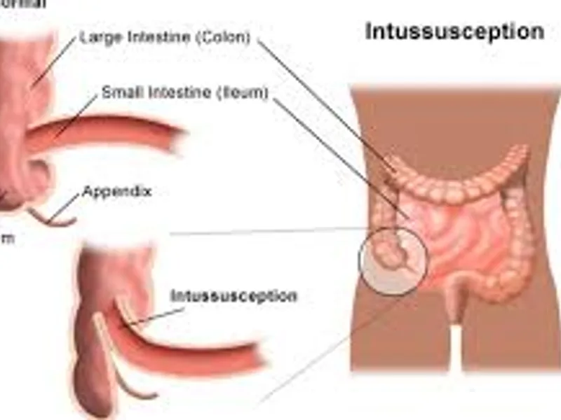 Child intussusception operation surgery in Deoghar