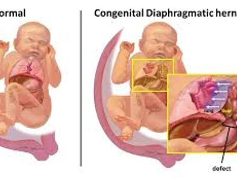 Diaphragmatic Hernia Repair Surgery in Deoghar | Cost, Best Surgeons & Hernia Treatment Guide