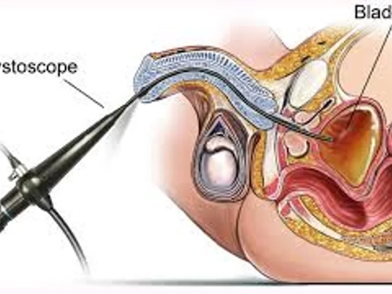 Child cystoscopic deroofing surgery in Deoghar