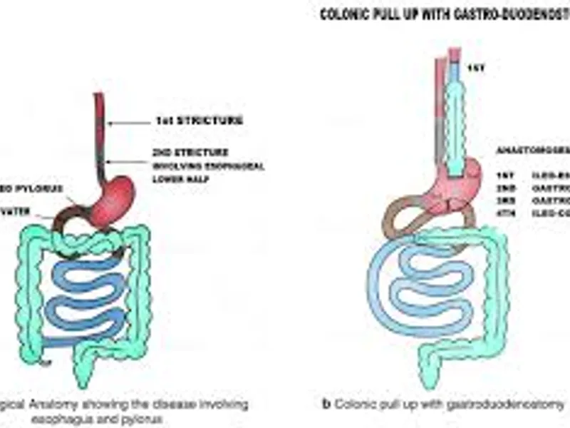 Colon Replacement of Esophagus Surgery in Deoghar | Cost, Best Surgeons & Colon Interposition Guide
