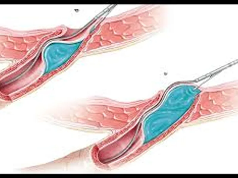 Child Cystoscopic Deflux Injection Surgery in Deoghar