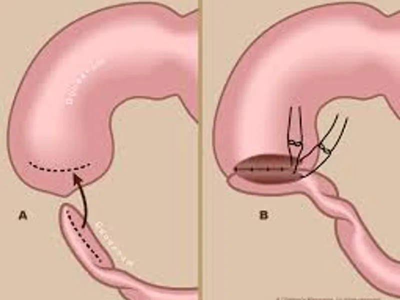 Duodenal Atresia Operation Surgery in Deoghar | Cost, Best Surgeons & Neonatal Intestinal Surgery Guide