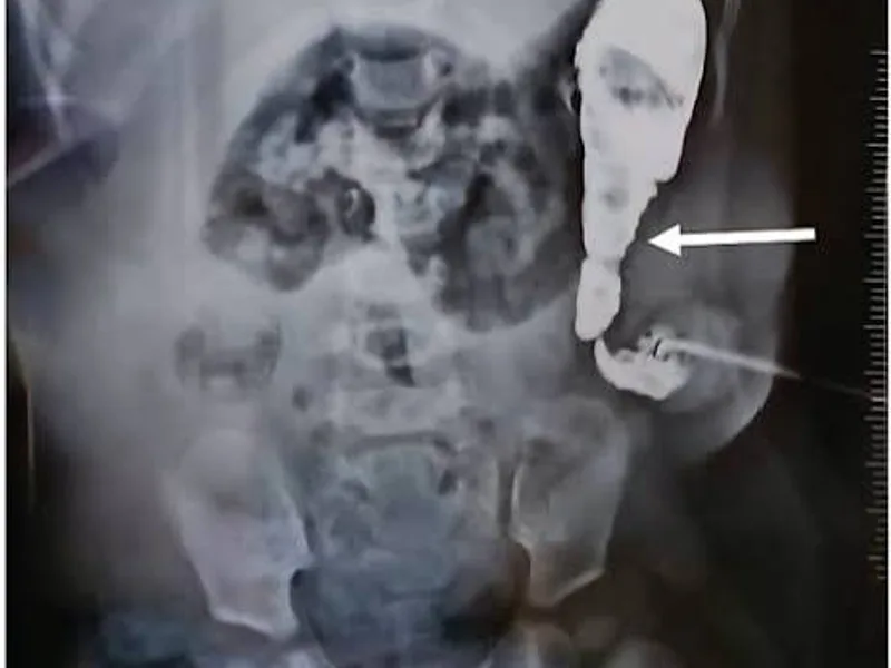 Hirschsprung Disease Colostomy & Biopsy in Deoghar