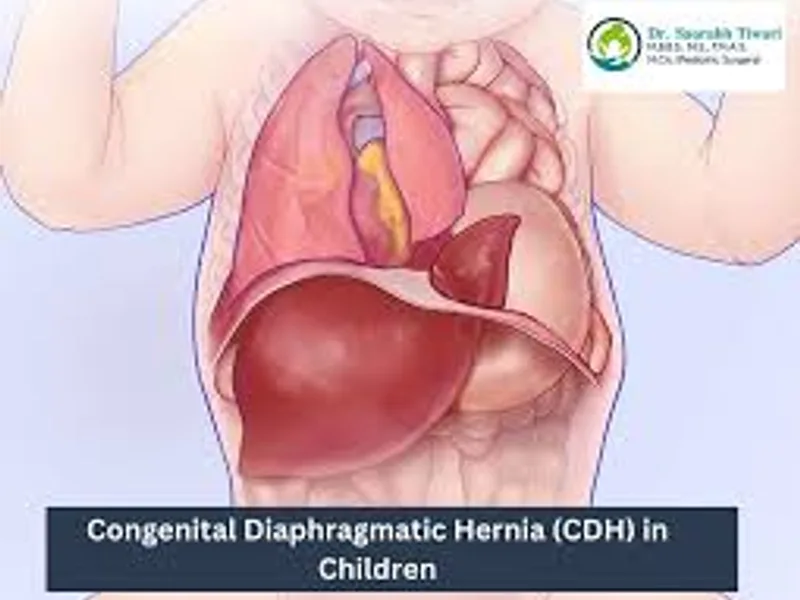Child diaphragmatic hernia repair surgery in Deoghar
