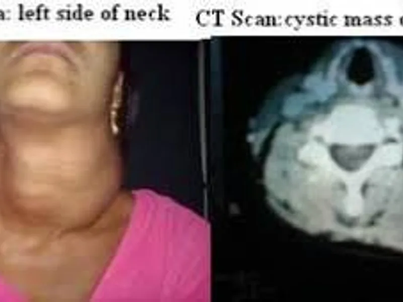Female Excision of Cystic Hygroma Surgery in Deoghar