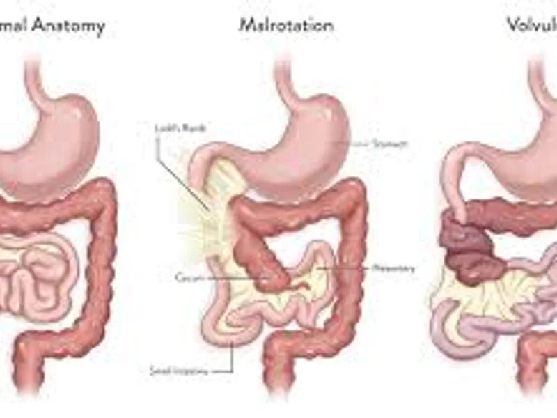 Malrotation of Gut Surgery in Deoghar