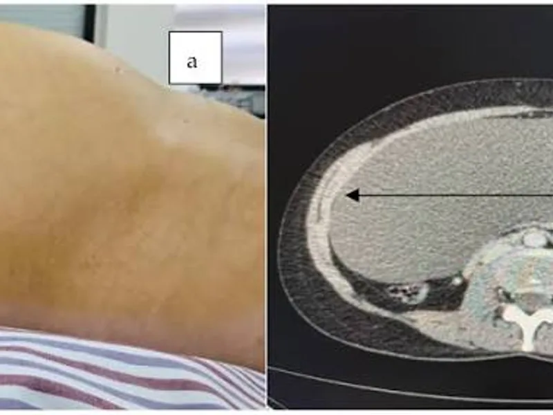Female Excision of Mesenteric Cyst Surgery in Deoghar