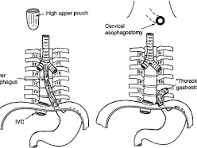 Child esophagostomy gastrostomy surgery in Deoghar