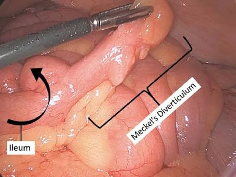 Female Meckel's Diverticulectomy Surgery in Deoghar