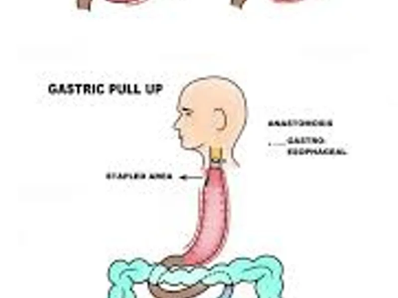 Child colon replacement of esophagus surgery in Deoghar