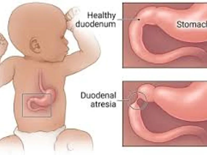Child Duodenal Atresia Operation Surgery in Deoghar