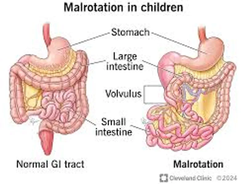 Child Malrotation of Gut Surgery in Deoghar