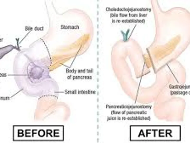 Child pancreatic ring operation surgery in Deoghar