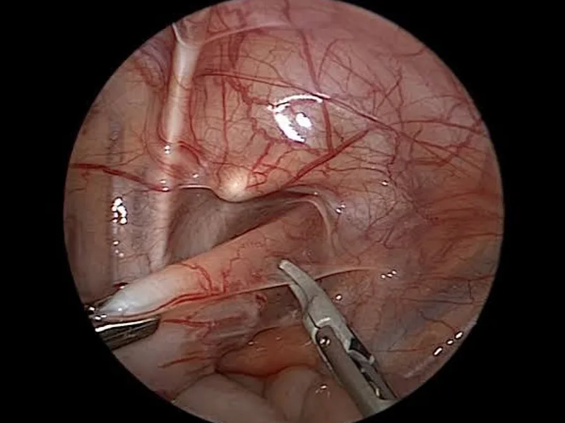 Female Imperforate Anus Low Anomaly Cut Back Operation in Deoghar
