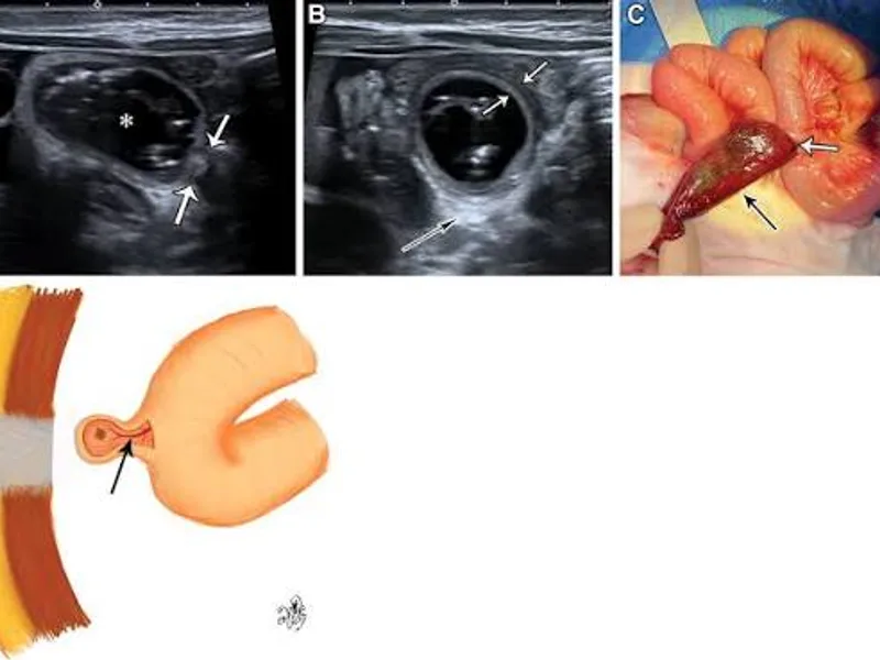 Female Omphalo Mesenteric Cyst Excision Surgery in Deoghar