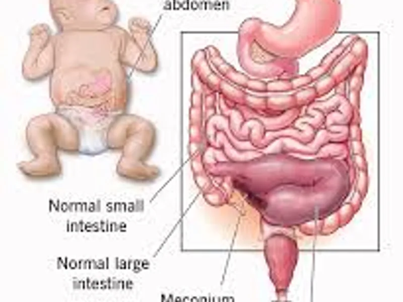 Child meconium ileus operation surgery in Deoghar
