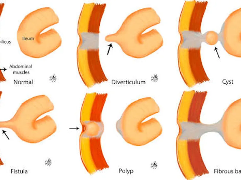 Female Omphalo Mesenteric Duct Excision Surgery in Deoghar