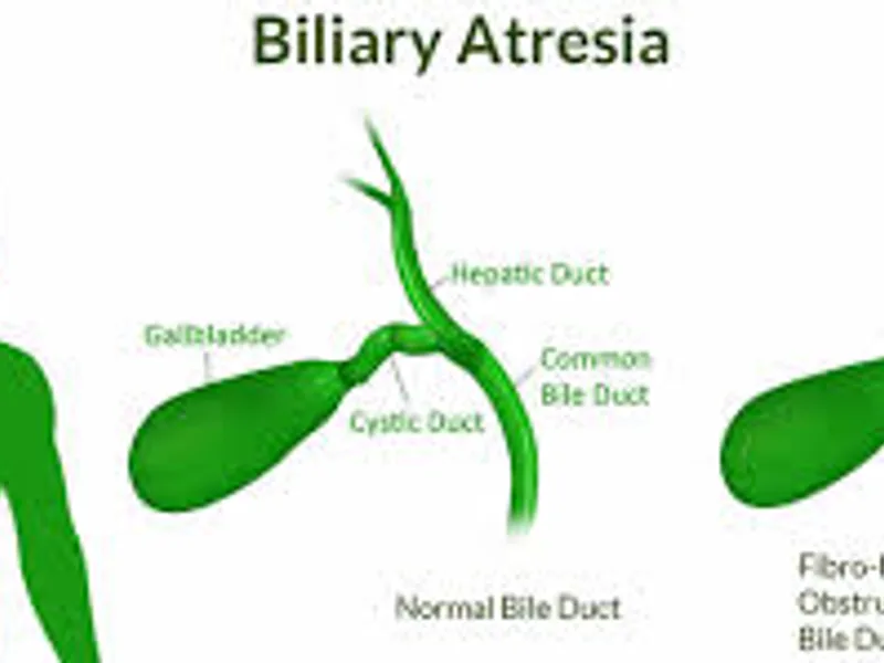 Atresia of Extra Hepatic Biliary Duct Surgery in Deoghar