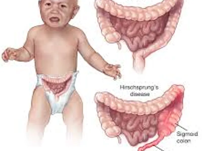 Child abdominal perineal pull through Hirschsprung disease surgery in Deoghar