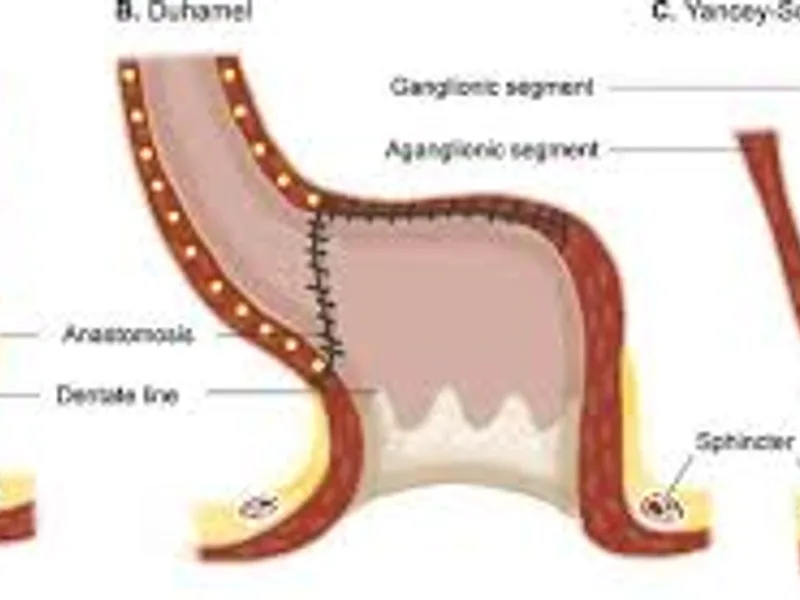 Child sacroabdominoperineal pull through surgery in Deoghar