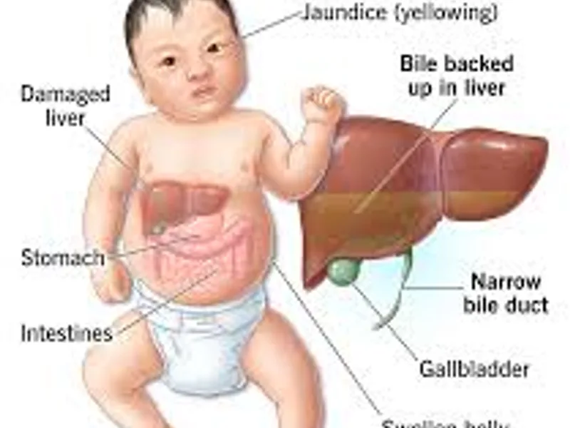 Child Atresia of Extra Hepatic Biliary Duct Surgery in Deoghar