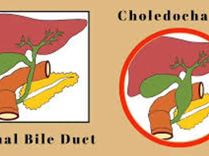 Child Choledochal Cyst Operation Surgery in Deoghar