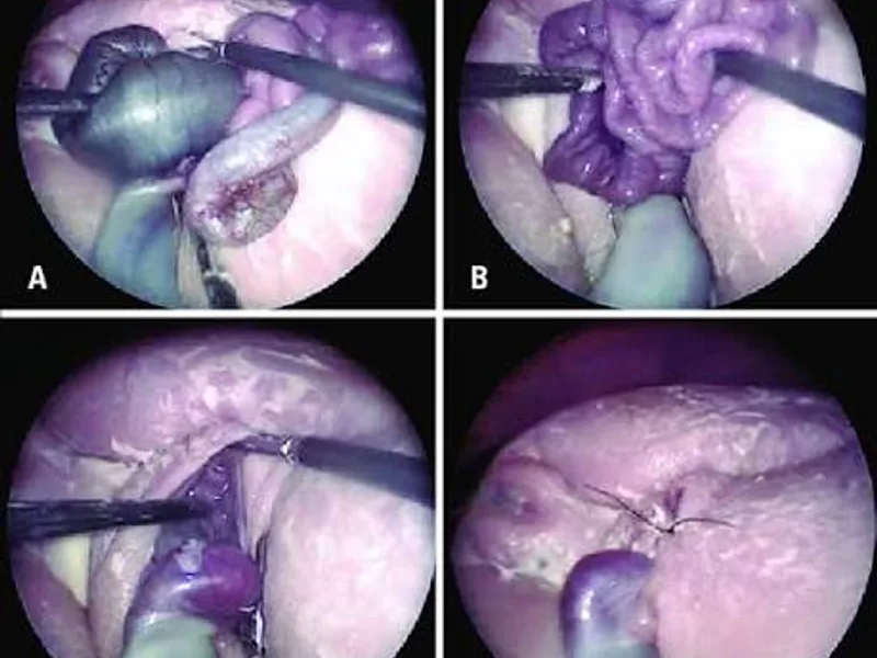 Female Gastroschisis Repair Surgery in Deoghar