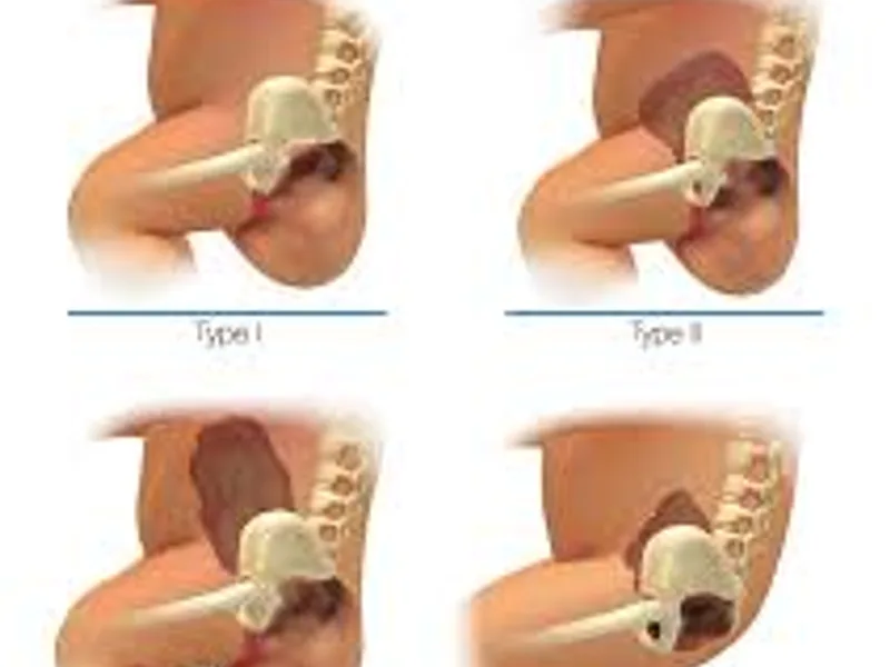 Sacrococcygeal Teratoma Excision Surgery in Deoghar