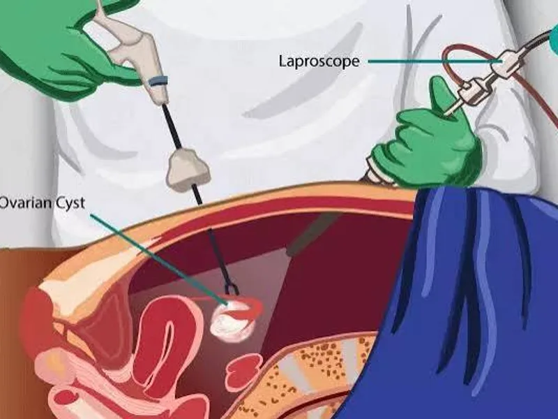Female Open Abdominal Cyst Operation in Deoghar
