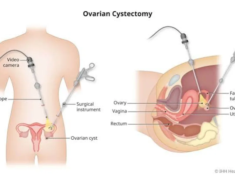 Female Laparoscopic Abdominal Cyst Operation in Deoghar