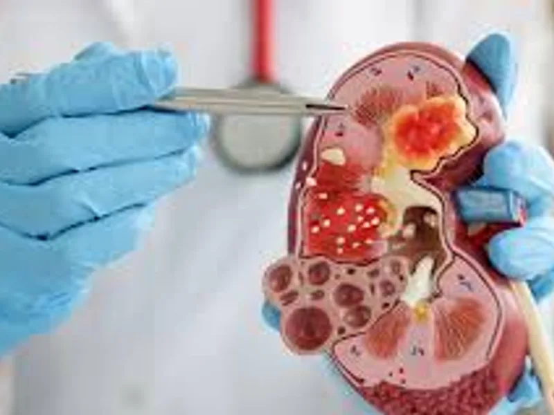 Child Nephrectomy for Wilms Tumour Surgery in Deoghar