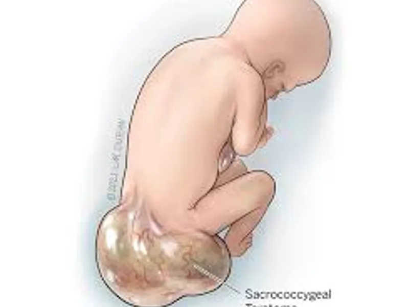 Child Sacrococcygeal Teratoma Excision Surgery in Deoghar