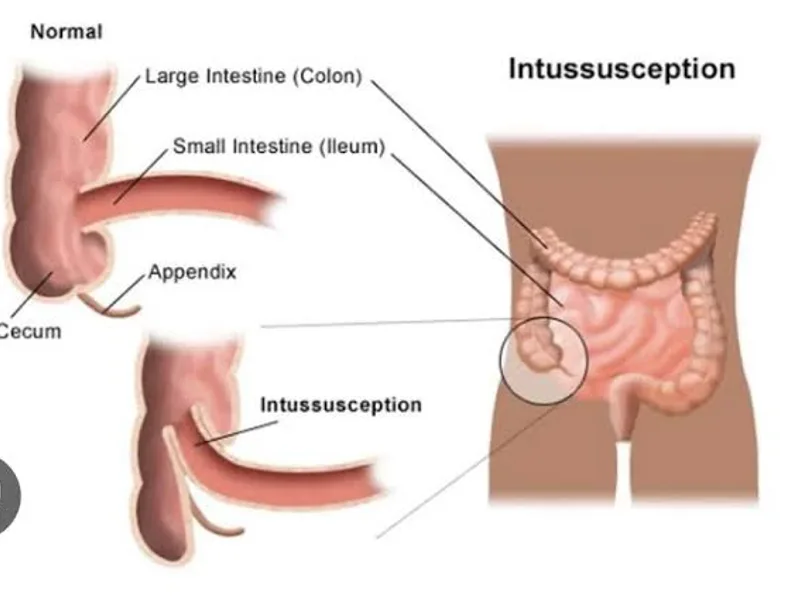 Female Intussusception Surgery Deoghar | Cost & Surgeons