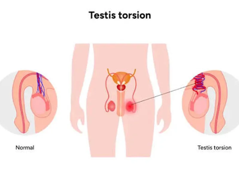 Female Torsion Testis Operation in Deoghar