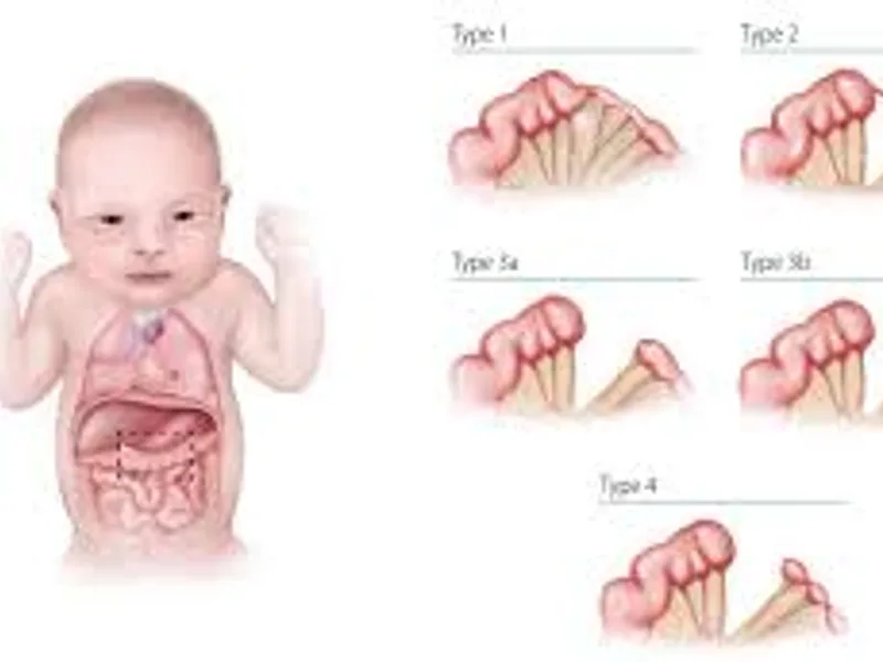 Congenital Atresia Stenosis Small Intestine Surgery in Deoghar