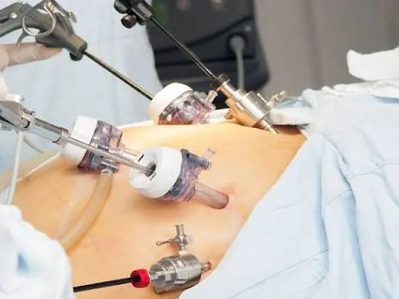Female Laparoscopic Cholecystectomy Surgery in Deoghar