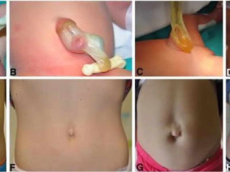 Female Omphalocele First Stage Hernia Repair Surgery in Deoghar
