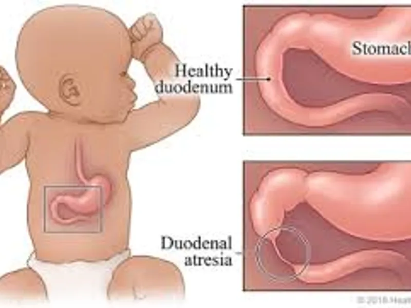 Child Congenital Atresia Stenosis Small Intestine Surgery in Deoghar